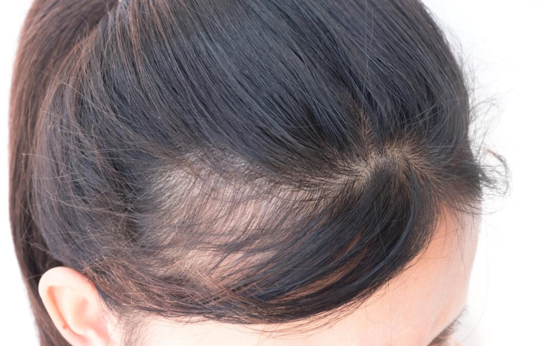 Who is a Good Candidate for PRP Hair Therapy